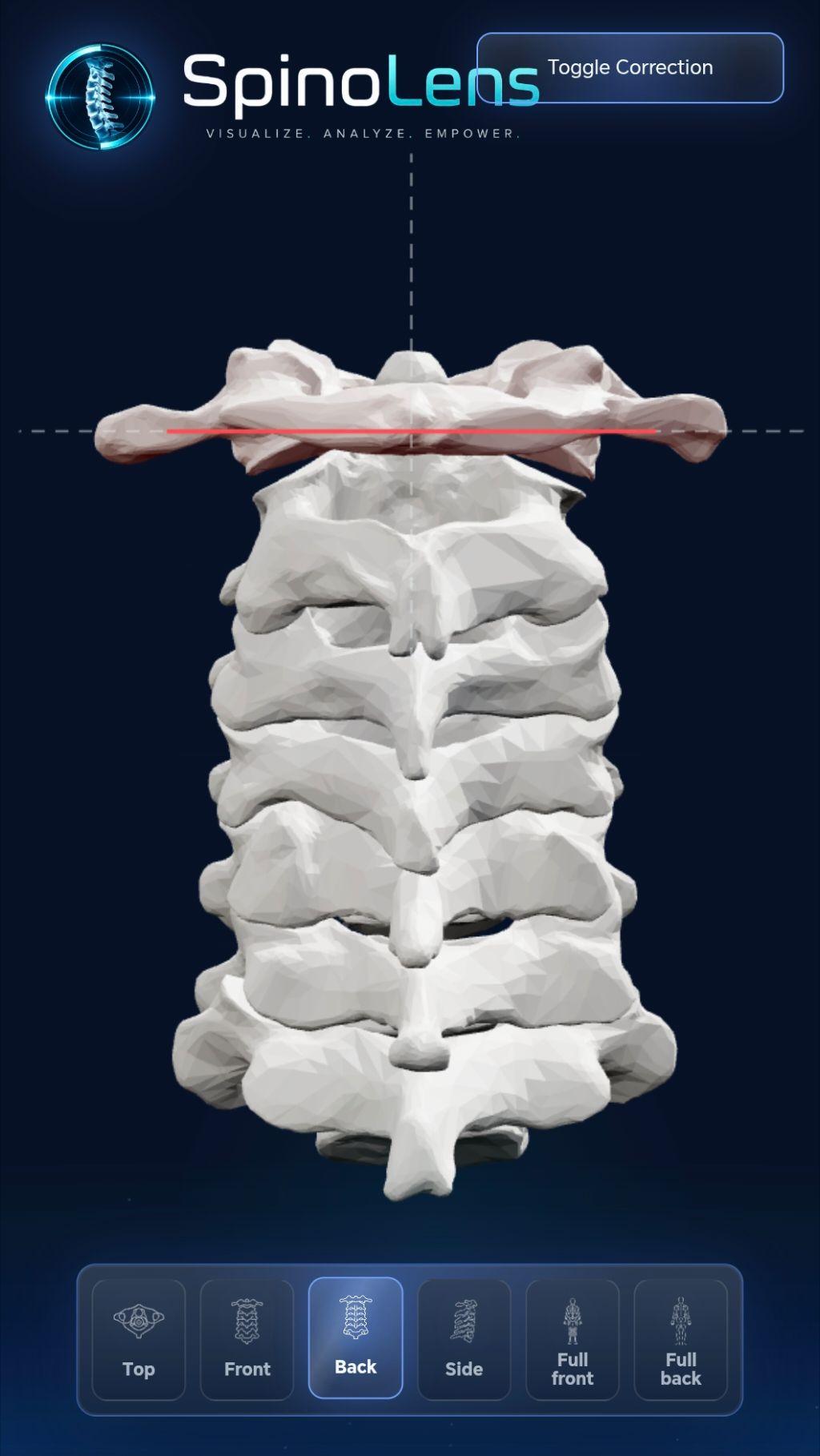 SpinoLens patient viewer shown on a mobile phone